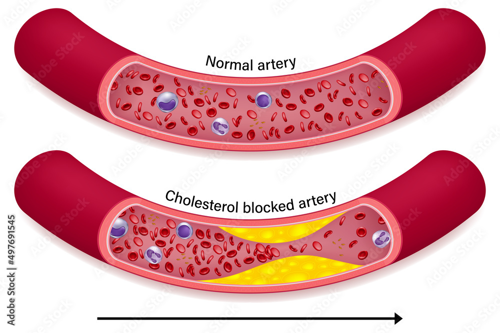 The difference of normal artery and cholesterol blocked artery. Clogged arteries caused by cholesterol. - obrazy, fototapety, plakaty 