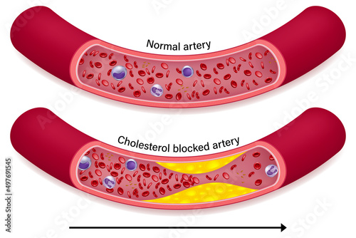The difference of normal artery and cholesterol blocked artery. Clogged arteries caused by cholesterol. photo
