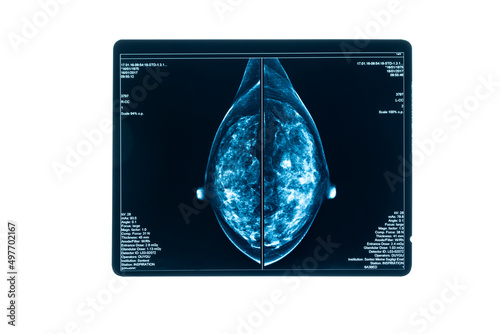 X-ray Digital Mammogram or mammography is x-ray image of the breast in women for screening Breast cancer.