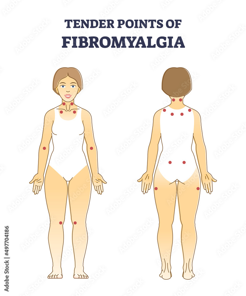 Tender points of fibromyalgia with pain location on body outline diagram Tender points of fibromyalgia with pain location on body outline diagram