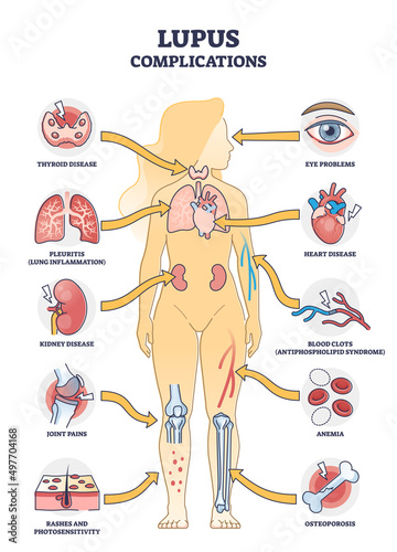 Lupus erythematosus medical autoimmune disease complications outline diagram