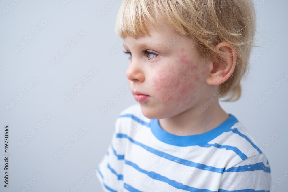 portrait of little boy with allergic rash or eczema on face. severe allergic reaction, atopic skin portrait of little boy with allergic rash or eczema on face. severe allergic reaction, atopic skin