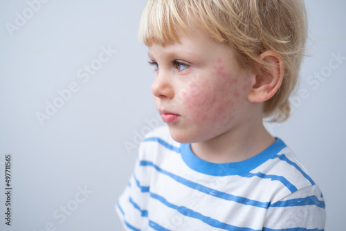 portrait of little boy with allergic rash or eczema on face. severe allergic reaction, atopic skin