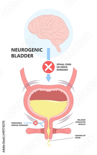 urge pass urine of pelvic floor muscle frequently Bed wetting toilet urination older nerve brain spasm tract tumor cancer stroke stress atonic Benign Lower Often leak anuria Neural Cystitis cord