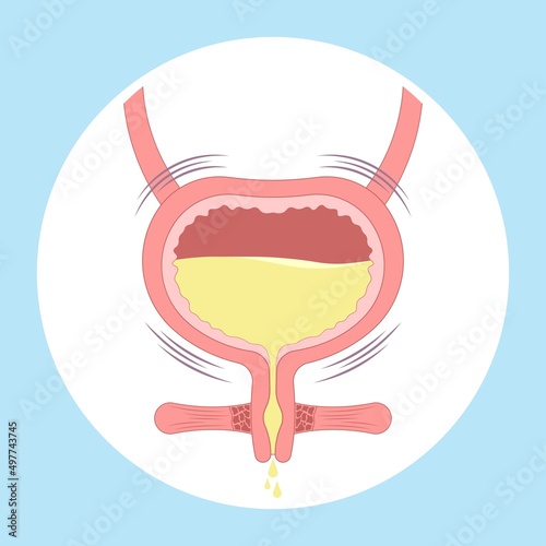 Cystitis anuria tumor cancer toilet frequently urination urge pass urine of pelvic floor muscle Bed wetting older nerve brain spasm tract stroke stress atonic Benign Lower Often leak Neural cord