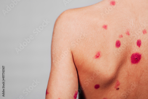 The back is in red dots. The concept of chickenpox. Smear pimples from chickenpox with a cotton bud. Place for text. Treatment of ulcers from chickenpox, varicella with medical cream on the kid skin