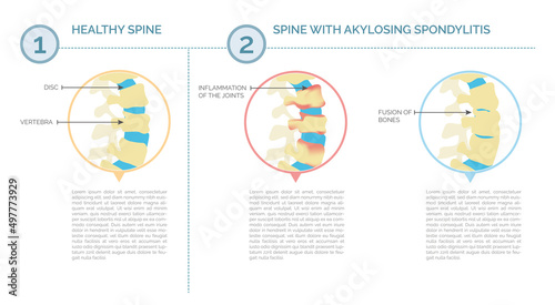Ankylosing spondylitis and healthy spine infographic