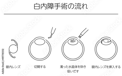白内障手術の流れ、図解イラスト（線画）