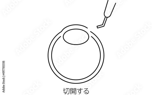 白内障手術の流れ、図解イラスト（線画）、切開する