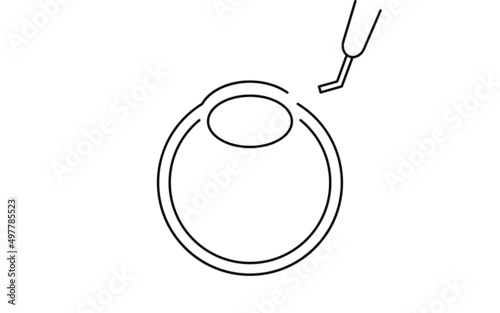 白内障手術の流れ、図解イラスト（線画）、切開する