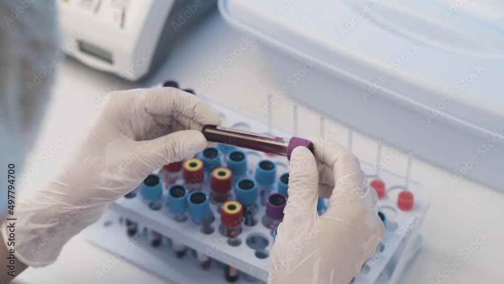 The Medic Carefully Examines the Test Tubes With Blood Samples. Concept: Research, Biochemistry, Pharmaceutical Medicine