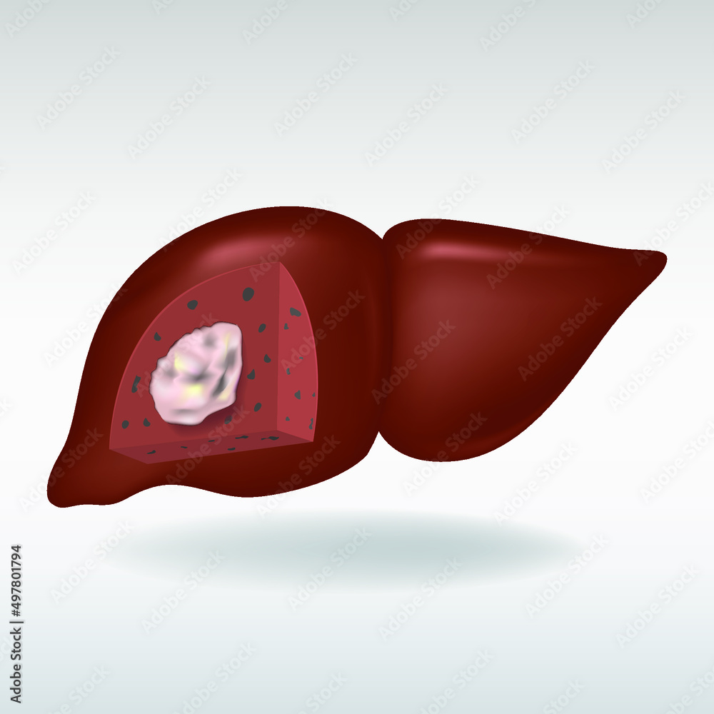 Model of the human liver with cut segment. Cancer tumor. Vector ...