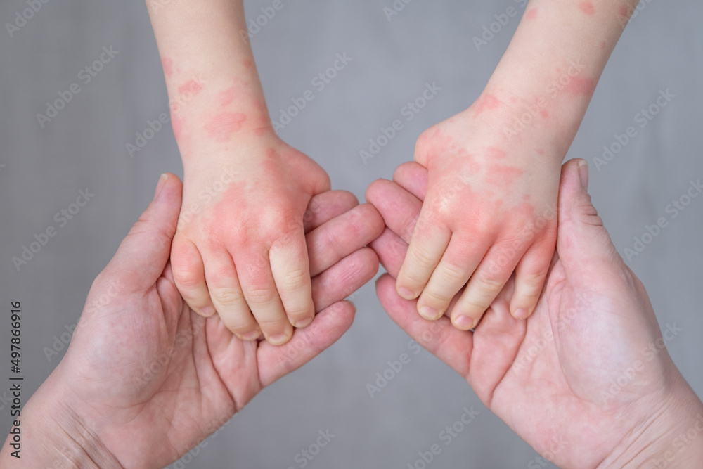 close up mother holding kids hands with allergic rash or eczema. severe allergic reaction, atopic skin - obrazy, fototapety, plakaty 