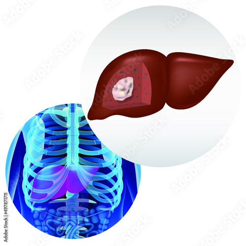 Liver cancer. Tumor in section. Disease infographics. Realistic rendering of the human body and internal organs. Vector illustration