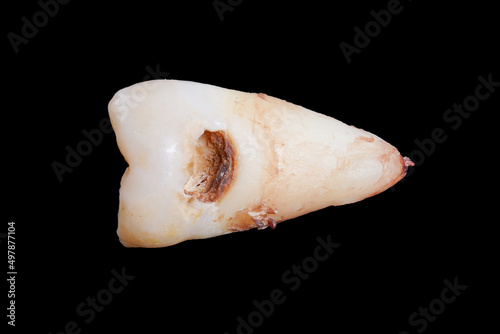 Close up of the broken wisdom tooth in isolated black background
