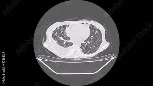 miliary tuberculosis, chest ct scan
 photo