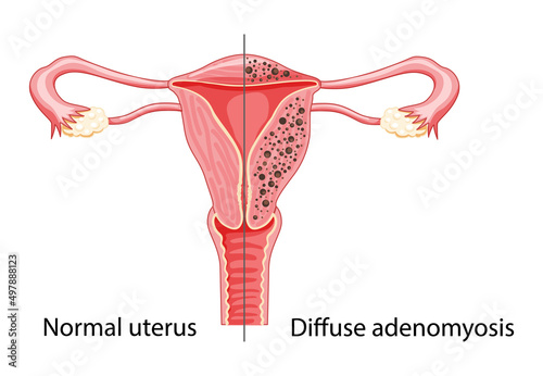 Diffuse Adenomyosis Human anatomy Female reproductive Sick system vs versus normal. Compared educational healthy and abnormal anatomy organs uterus icon flat cartoon vector illustration isolated