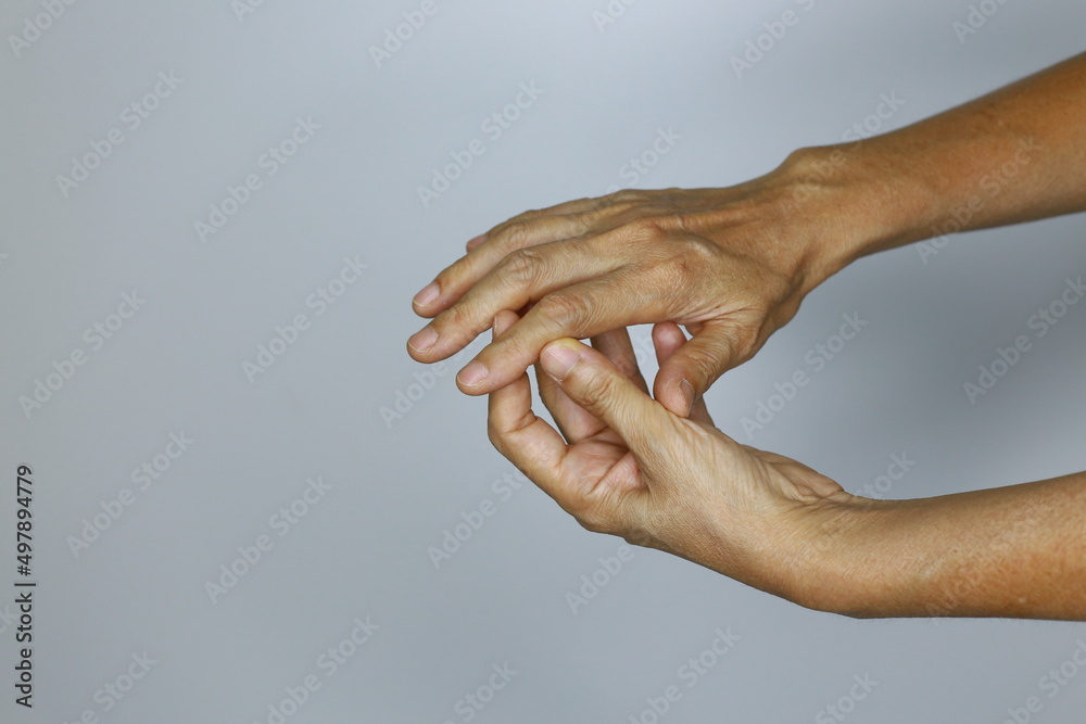 close-up woman hand of rheumatoid patient close-up woman hand of rheumatoid patient