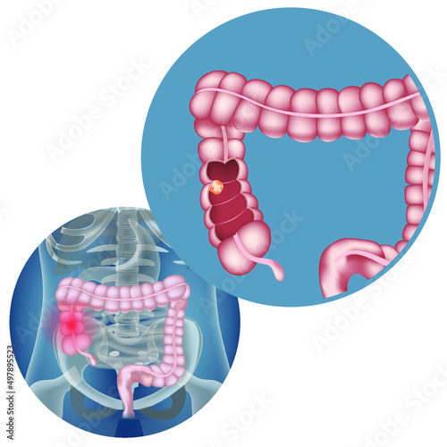 Neoplasm in the intestine. Disease infographics. Realistic rendering of the human body and internal organs. Vector illustration