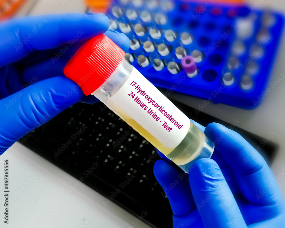 17Hydroxycorticosteroid 24 hours urine test, to diagnose Cushing 17Hydroxycorticosteroid 24 hours urine test, to diagnose Cushing