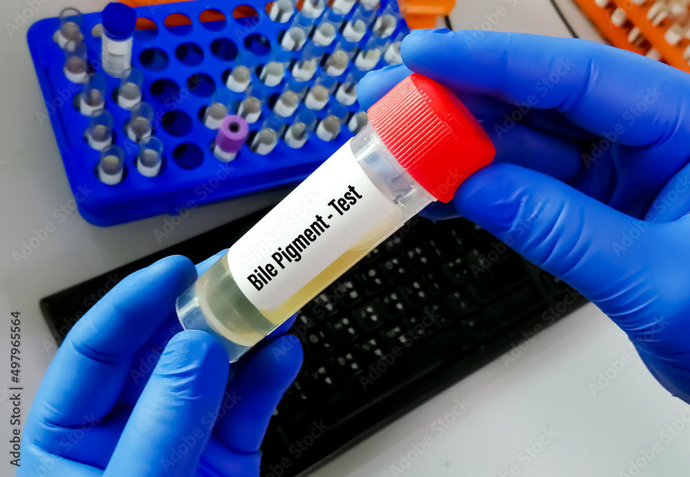Urinary bile pigment test with laboratory background. Urinary bile pigment test with laboratory background.