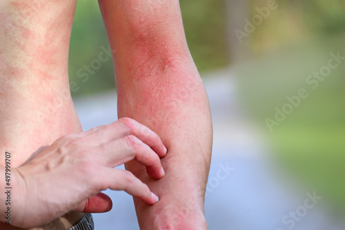man suffering from itching on arm skin body and scratching an itchy place. Allergic reaction to allergic a caterpillar sting or insect bites, dermatitis, food, drugs. Health care concept. photo