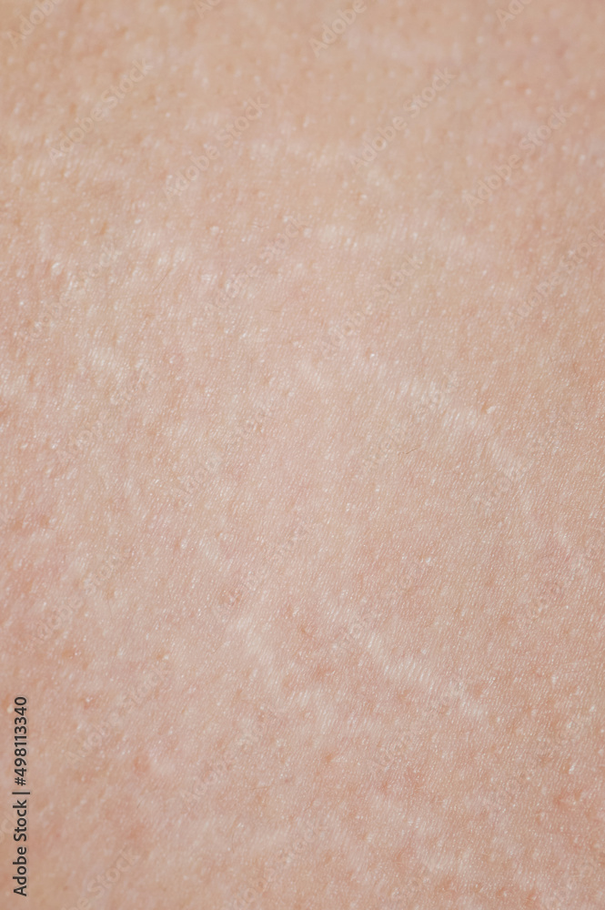 Fototapeta premium Stretch marks on human skin