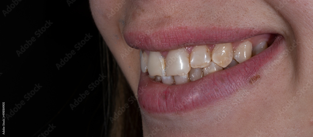Obraz premium dental macro photography, ceramic crowns and veneers
