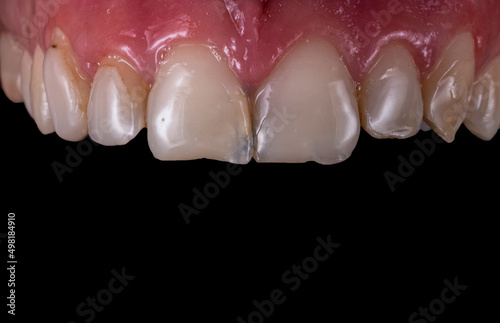 dental macro photography, ceramic crowns and veneers