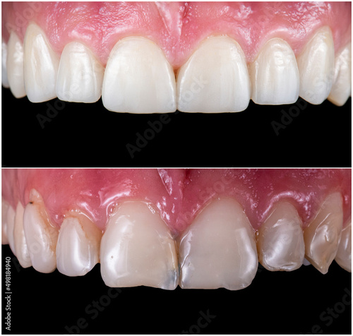 dental macro photography, ceramic crowns and veneers