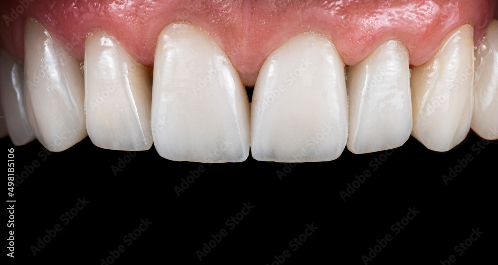 Obraz premium dental macro photography, ceramic crowns and veneers