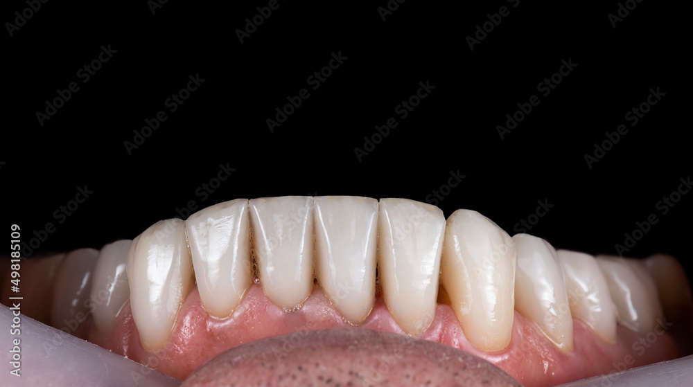 dental macro photography, ceramic crowns and veneers dental macro photography, ceramic crowns and veneers