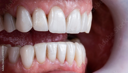 dental macro photography, ceramic crowns and veneers