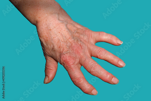 An Old Woman's Hand, Deformed From Rheumatoid Arthritis, highlighted on a blue background. photo