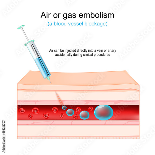 Air or gas embolism. blood vessel blockage.