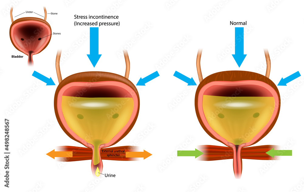 Overactive bladder OAB and Normal bladder.Illustration showing Detrusor