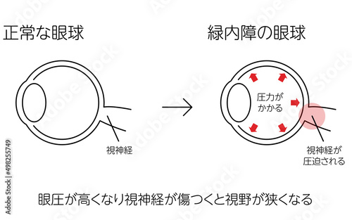 緑内障の仕組みの図解、正常な眼球と緑内障の眼球、メディカルイラスト photo