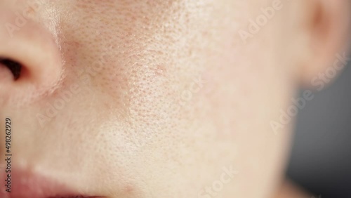 Skin texture, unhealthy with with enlarged pores and rosacea, red rashes. Environmental impact on sensitive skin concept. Selective blurred focus. photo