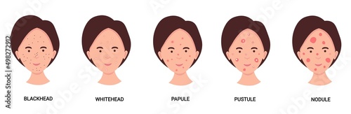 Woman face with different types of acne. Medical illustration in cartoon style 