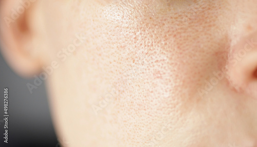 Skin texture, unhealthy with with enlarged pores and rosacea, red rashes. Allergic and redness. Environmental impact on sensitive skin concept.  photo