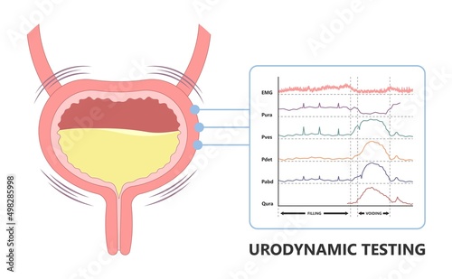 pelvic muscle floor weak cancer diagnostic therapy urination study test urine leak EMG Urethral flow often tract exam diagnose bio feedback kidney organ pain urge toilet enlargement stress outlet