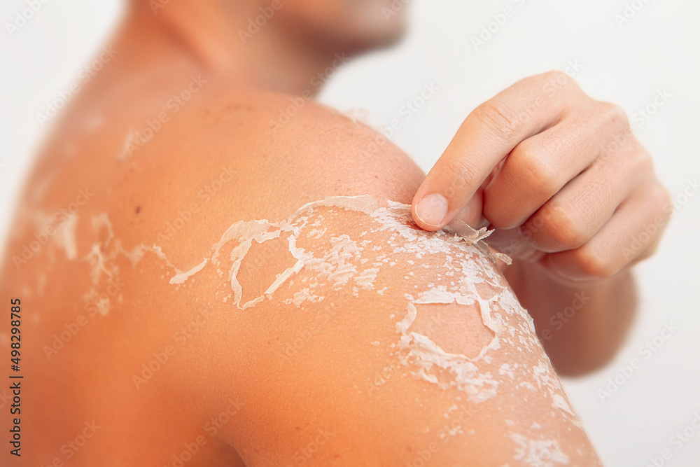 Fototapeta premium Peeling skin at man back and shoulder from sunburn, flaking skin and skincare concept