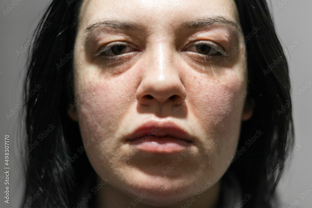 Caucasian woman with allergic reaction. Problematic face skin. Symptoms of allergic reaction. Acne problems. Close up photo. - obrazy, fototapety, plakaty 