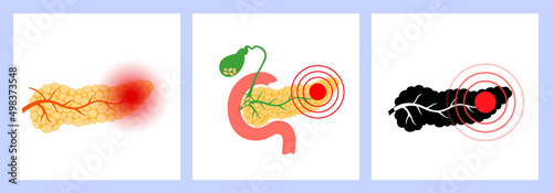 Pancreas disease and cancer