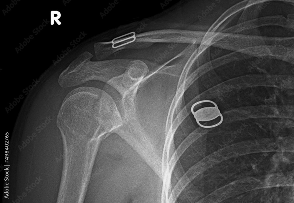 X ray Image Of Proximal Humerus Fracture Stock Photo Adobe Stock