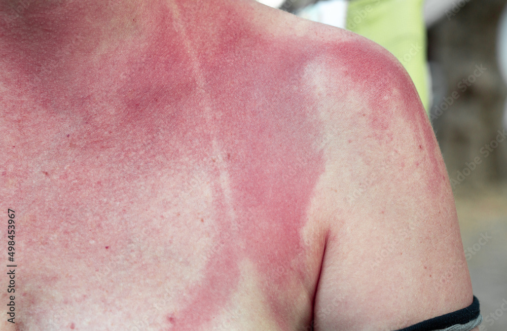 Fototapeta premium Red skin and swimsuit sign of a woman who has been in the sun in the hot summer hours