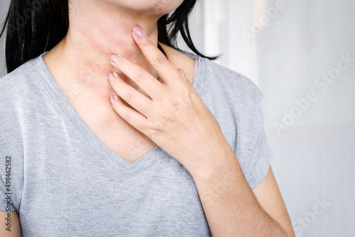 Canvastavla woman hand scratching on her neck, itchy skin