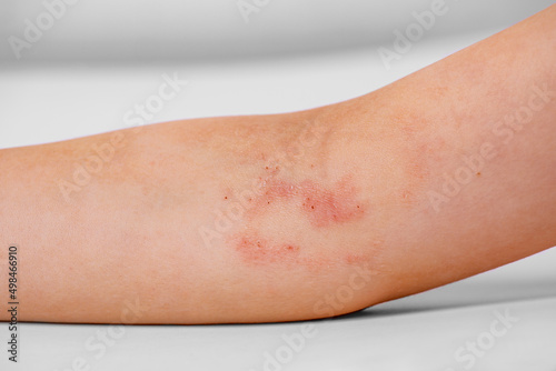 atopic dermatitis on the child's arm