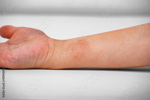 atopic dermatitis on the child's arm photo