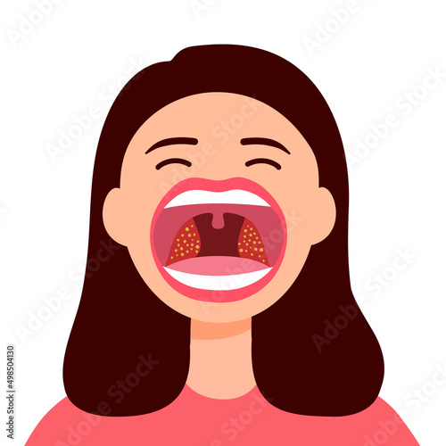 Woman open mouth with tonsils throat infection in flat design on white background.